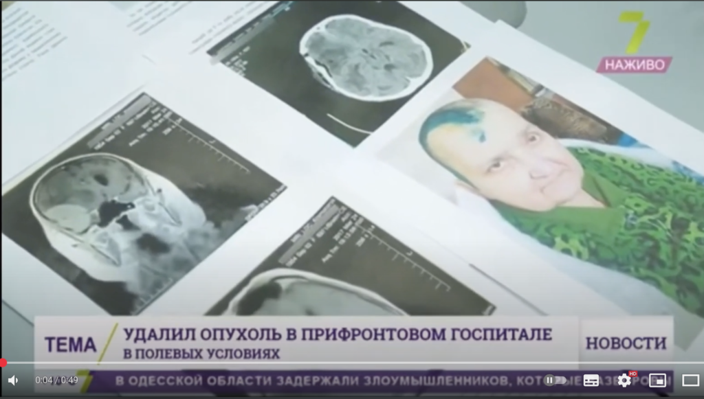 У прифронтових умовах Юрій Гафійчук видалив величезну пухлину головного мозку