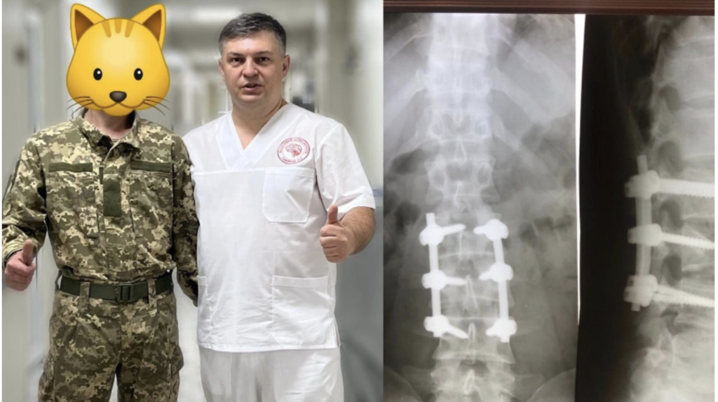 Одеський нейрохірург Юрій Гафійчук повернув військовому здатність ходити!